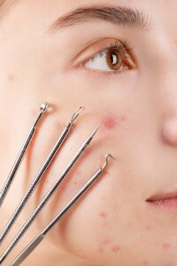 Fungal Acne
