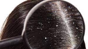 Prevent Dandruff