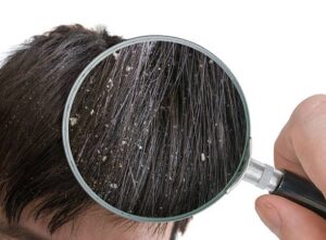 Dandruff