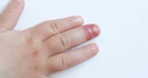 Ingrown Fingernail Infection