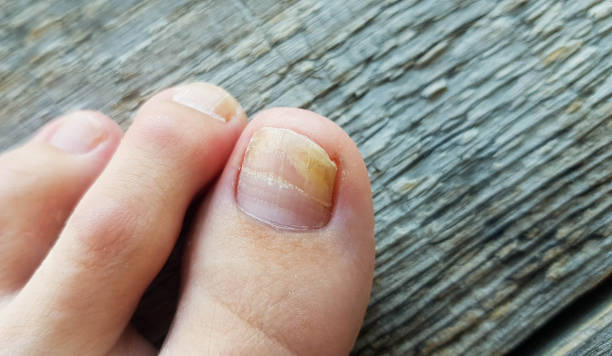 Ingrown Fingernail