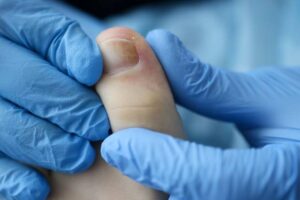 Ingrown Fingernail
